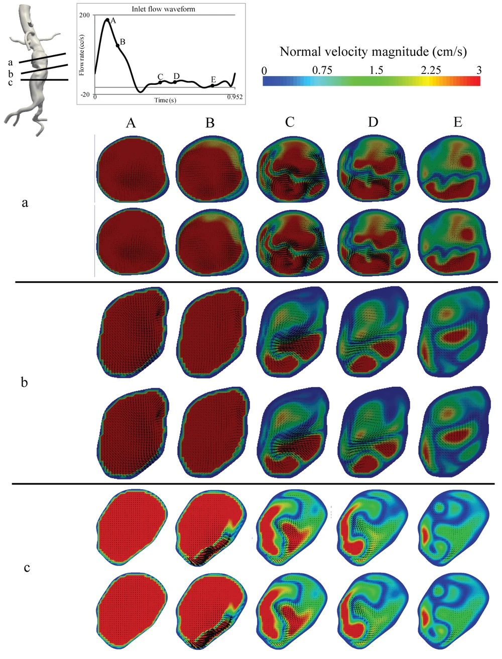Patient-specific lumen geometry, velocity at peak systole and through deceleration, the instantaneous field beside the phase-averaged one, and convergence against the number of cycles averaged