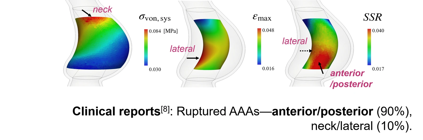 The same aneurysm mapped twice — equivalent wall stress on the left, stress-to-strength ratio on the right — with the regions each measure emphasises marked