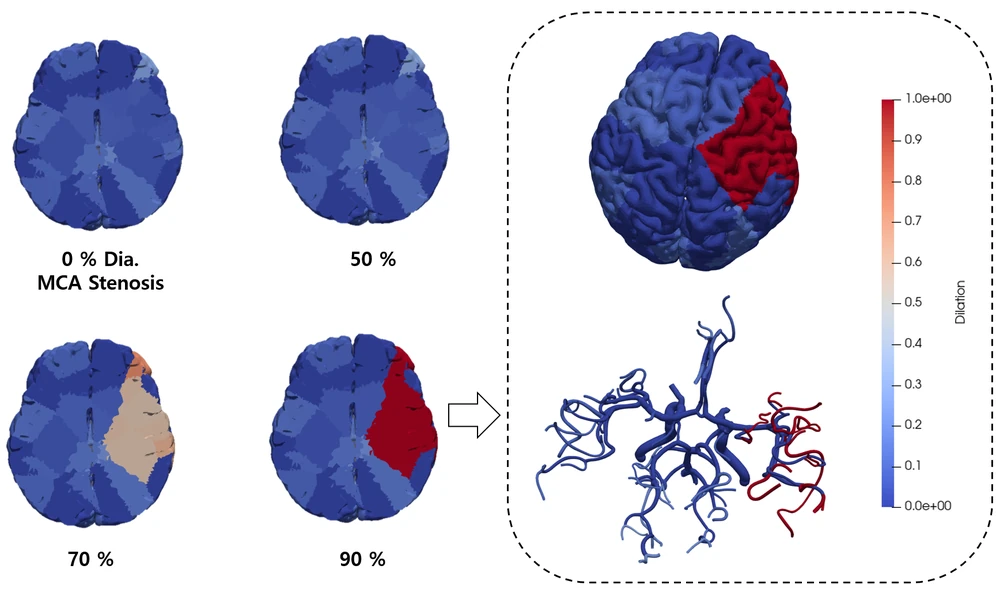 Normal vessels with baseline perfusion, the same tissue under stenosis with the hypoperfused region marked, and perfusion after arteriolar vasodilation