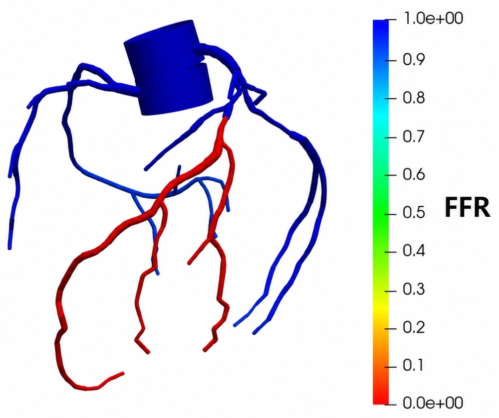 Patient-specific coronary simulation — anatomy with computed pressure field