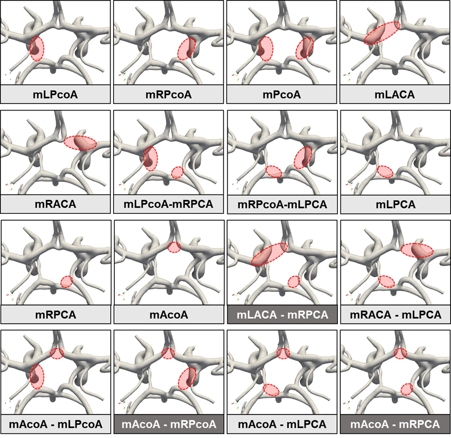 A complete Circle of Willis beside an incomplete or asymmetric one, each marked with inlet flow, communicating arteries, pressure distribution, flow direction and the vessel with reduced inflow — labelled as a study configuration
