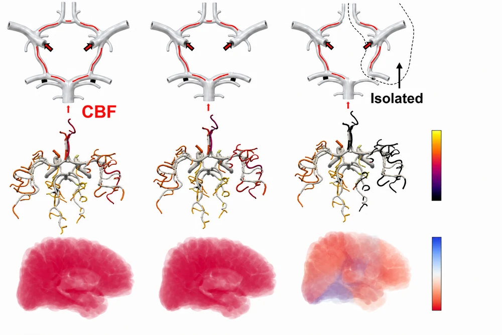 The Circle of Willis opening out along the major arteries into synthetic arteriolar trees, a stenosis on one artery, the territory behind it losing perfusion, and the collateral pathways that carry flow back to it